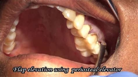 extraction  decayed upper molar tooth youtube