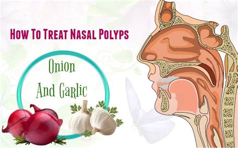 30 tips on how to treat nasal polyps naturally at home page 2