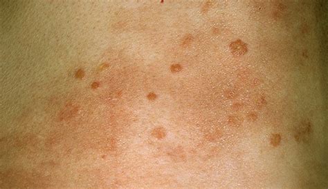 hiv rash symptoms characteristics pictures and treatment