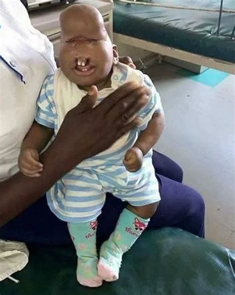 breaking barriers  special baby   severe facial deformity