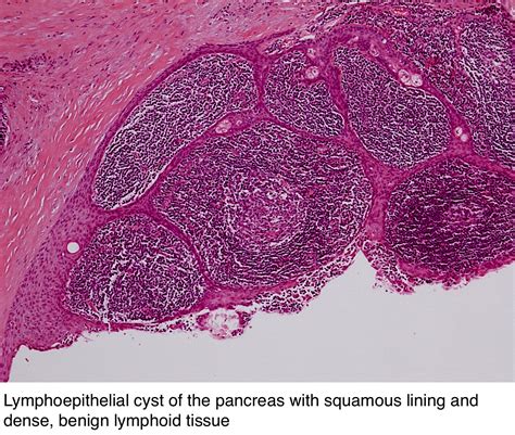 pathology outlines lymphoepithelial cysts