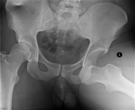 avascular necrosis bilateral hip joints buyxraysonline
