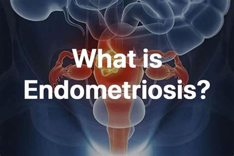 Endometriosis Endometriosis Happens When The Endometrium Tissue That