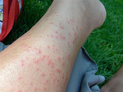 treat heat rashes doctor tipster