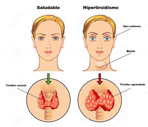 síntomas del hipertiroidismo qué es causas y tratamiento