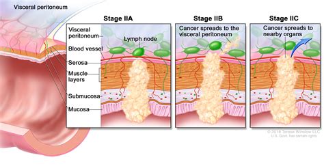 Adenocarcinoma Adenocarcinoma Stage 3b