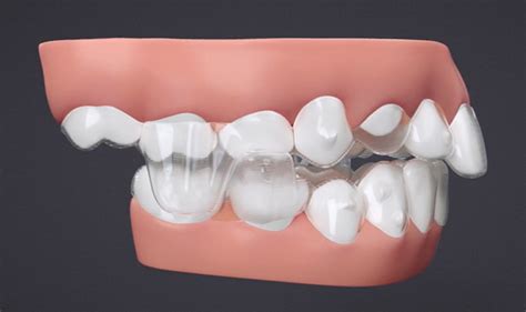 invisalign  mandibular advancement innovative orthodontic centers