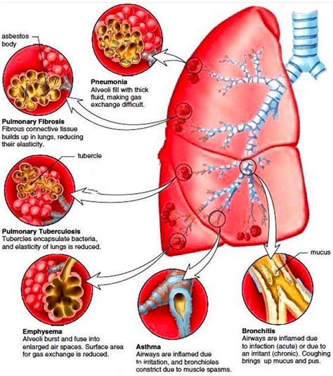 The Resuscitationist On Instagram “pulmonary Pathologies