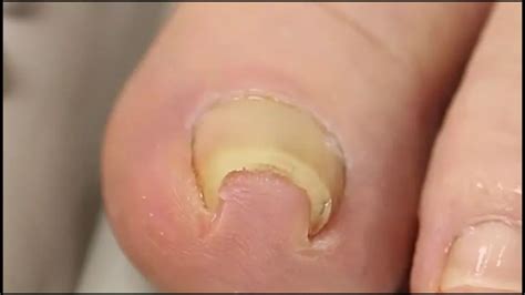 method  fixing  ingrown toenail   genius  disgusting