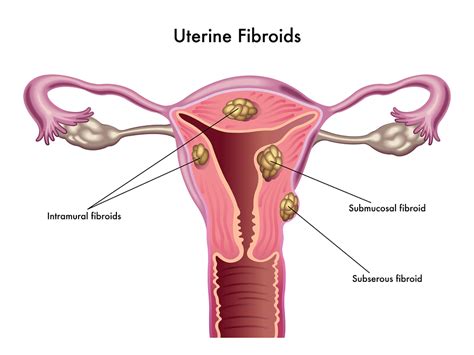 Uterine Fibroids Leiomyoma Toronto Naturopath
