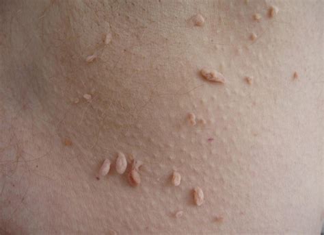 natural remedies for common skin problems warts dark
