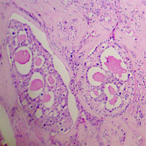 Cureus Unclassified Mixed Germ Cell Sex Cord Stromal Tumor Of The