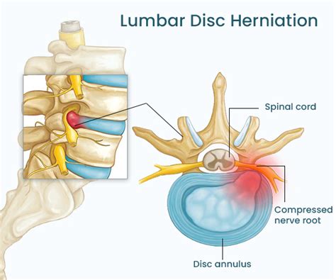 spinal disc protrusion