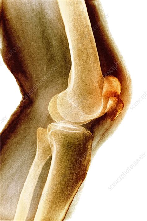 Fractured Kneecap X Ray Stock Image M330 1567 Science Photo Library