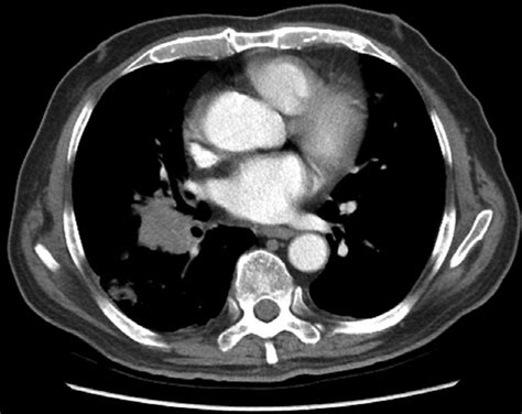Right Lower Lobe Mass Conforms To Malignant Features With Mediastinal