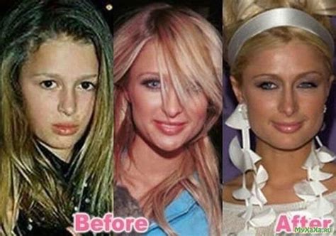 Paris Hilton Before And After Plastic Surgery