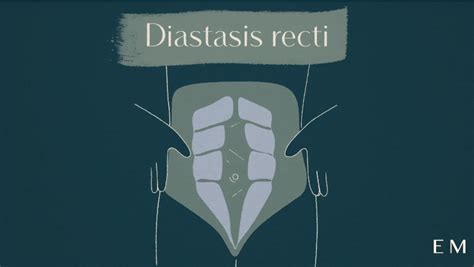 “what is diastasis recti” an interview with ob gyn dr jaqueline worth