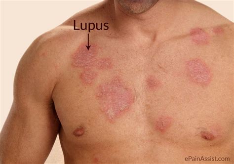 lupus  signs symptoms treatment lifestyle modifications