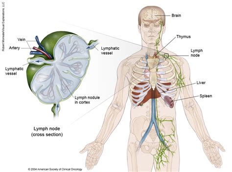 Lymphoma Non Hodgkin Medical Illustrations Cancer Net