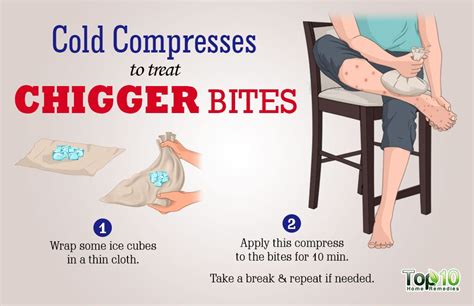 treat chigger bites top  home remedies