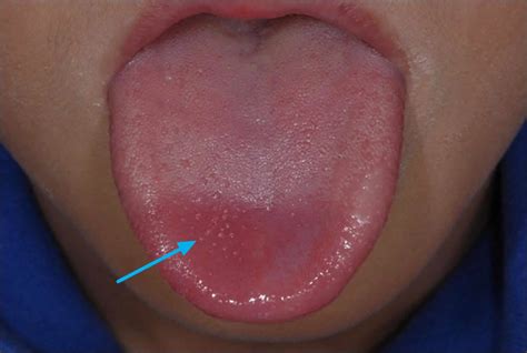 transient lingual papillitis  lie bumps   lie bumps treatment