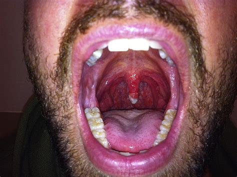 uvula necrosis  atypical   sore throat journal  emergency medicine