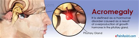 acromegaly treatment symptoms causes diagnosis