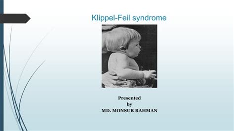 Klippel Feil Syndrome Ppt