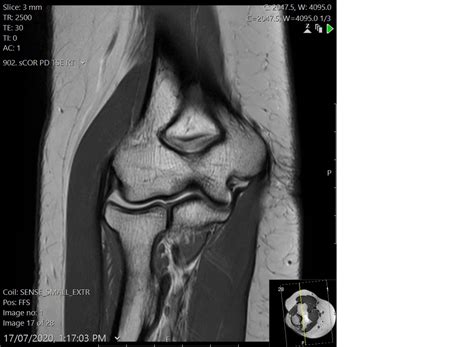 mri elbow radiology template reports