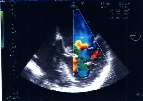 Mitral Supravalvular Ring A Case Report Cardiovascular Ultrasound