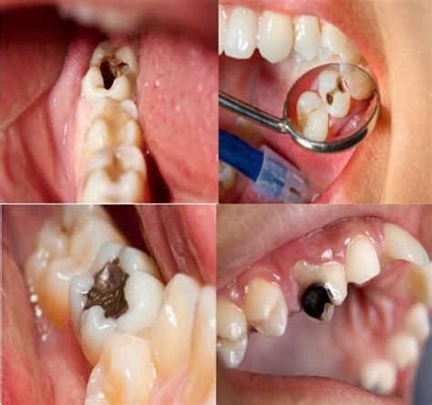 tooth cavity   public health