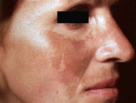 melasma  treatment affects skin  color society