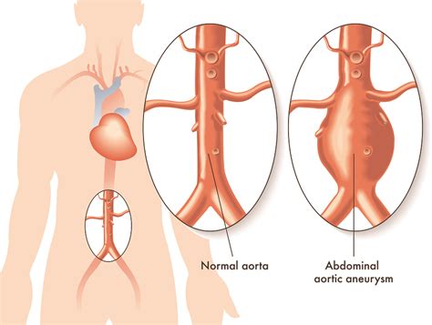 aneurysma  der bauchschlagader verlauf diagnose und behandlung