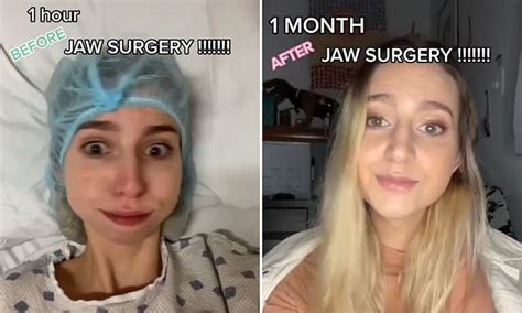 Woman Shows Off Her Stunning Transformation After Major Jaw Surgery