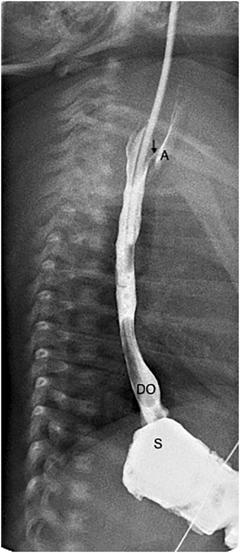 H Type Congenital Tracheoesophageal Fistula Insights From 70 Years Of