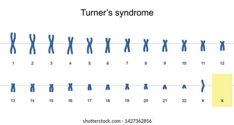 Turners Syndrome Karyotype Nondisjunction Sex Chromosomes Vector De