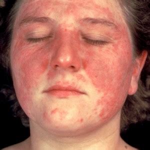 acne rosacea symptoms  diagnosis  treatment natural health news