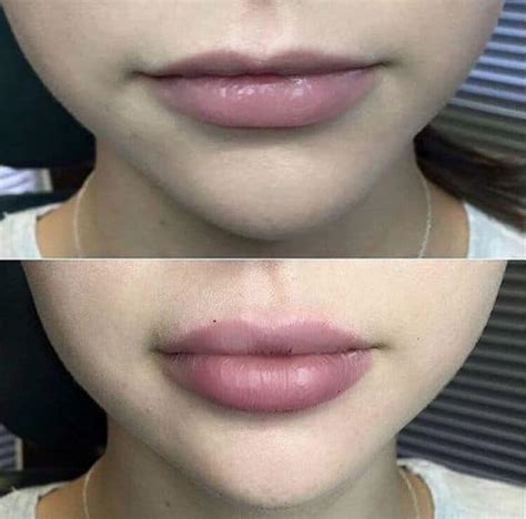 Lip Fillers And Why Is Everyone Getting Them The Fashion Tag Blog