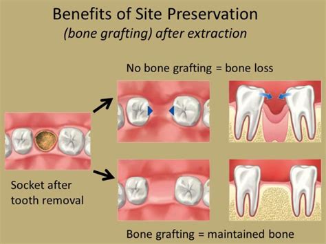 bone grafting  dentistry