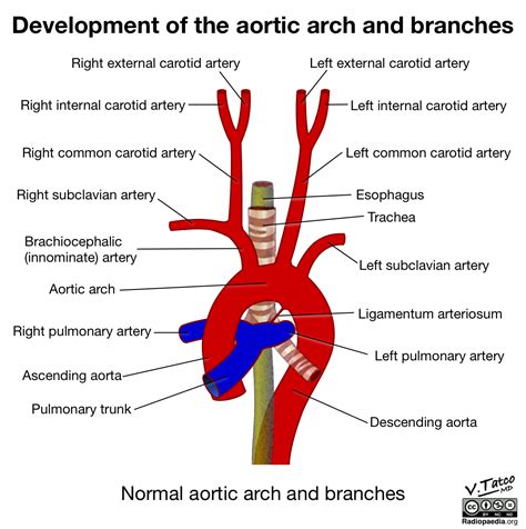 radiopaedia drawing aortic arch   branches english labels