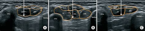 Ultrasonographic Analysis Of Optimal Needle Placement For Extensor Indicis