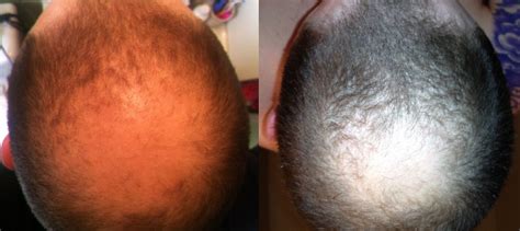 scalp massage mega thread results photos techniques top hair loss