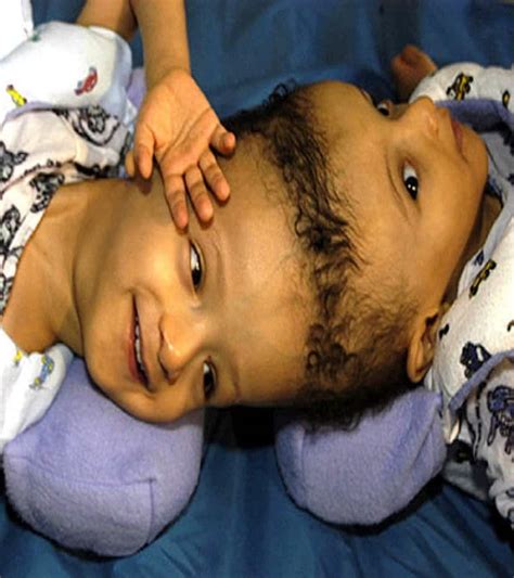 12 Insane Photos Of Conjoined Twins