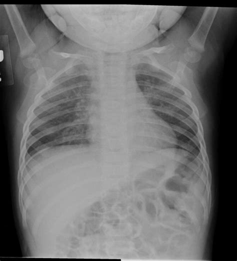 normal cxr report   document  chest  ray cxr   notes