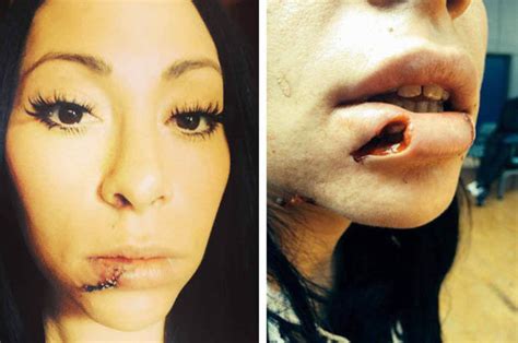 it could have ripped my whole lip off pregnant woman attacked by