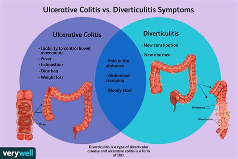 divertikulitis  colitis ulcerosa  sind die unterschiede medde
