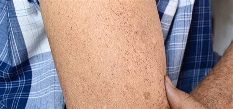 brown spots dermatology  skin health dr mendese
