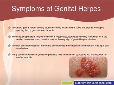 genital herpes in women genital herpes in women
