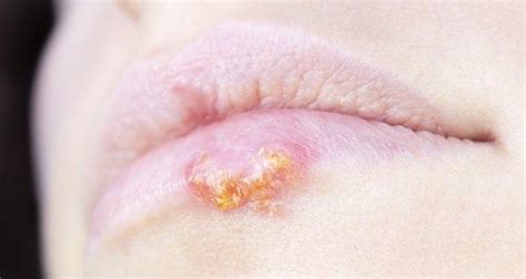 6 common signs and symptoms of herpes read health related blogs articles and news on diseases