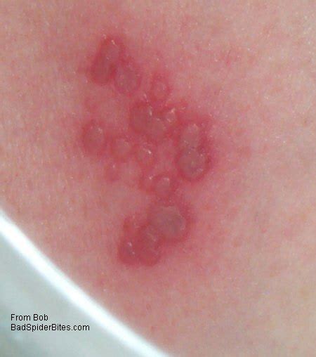 Bug Bites Blisters Pictures Photos